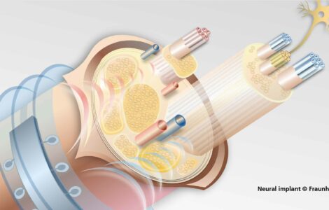 Neural Implant, Fraunhofer IZM