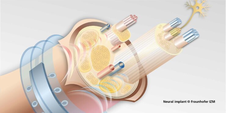 Neural Implant, Fraunhofer IZM